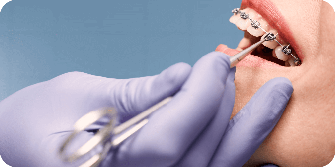 An individual at the orthodontist, getting their braces checked.