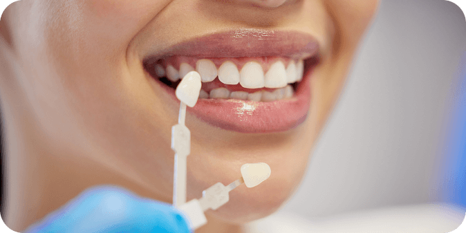 Someone smiling while colour matching their teeth with colour samples