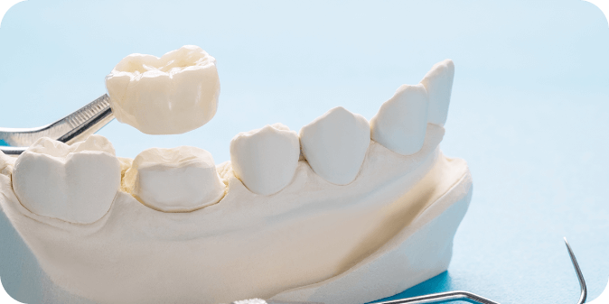 A model of teeth with a dental crown being held above it