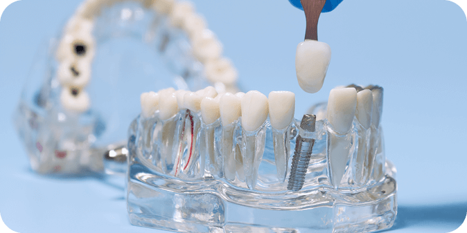 A model of jaws and teeth with a dental implant