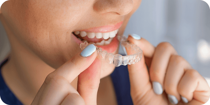 A lady smiling and putting on Invisalign.