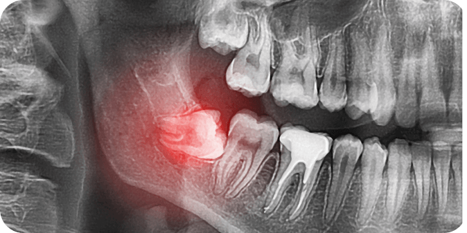 X-Ray of an impacted wisdom tooth.