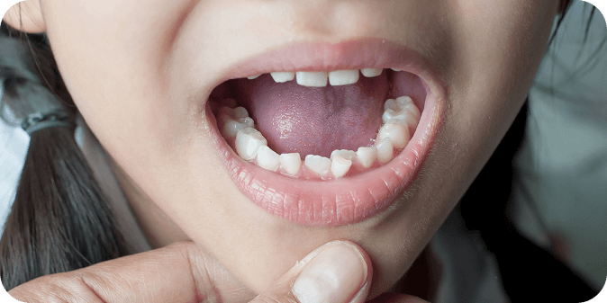 An open mouth with overcrowded teeth