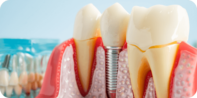 A cross-section image of 3 teeth with a dental implant.