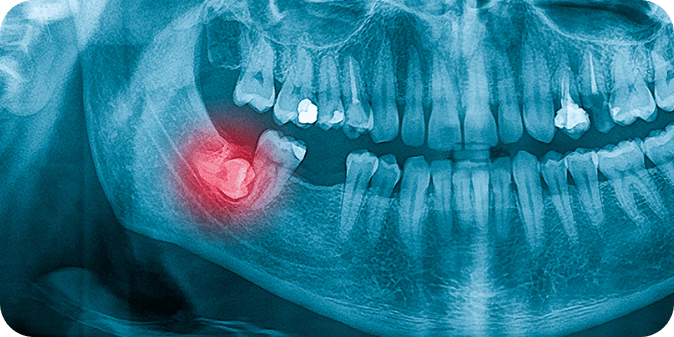 X-Ray of impacted wisdom tooth
