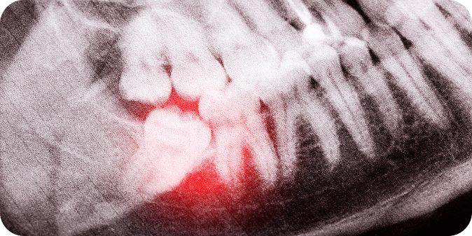 An X-Ray of an impacted wisdom tooth