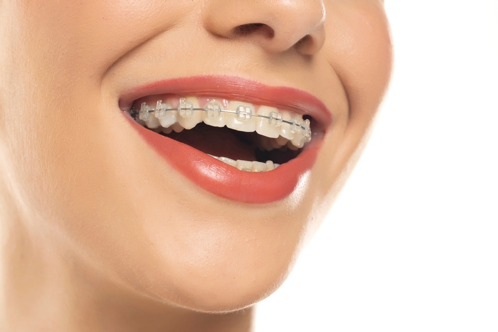 types of braces: ceramic braces