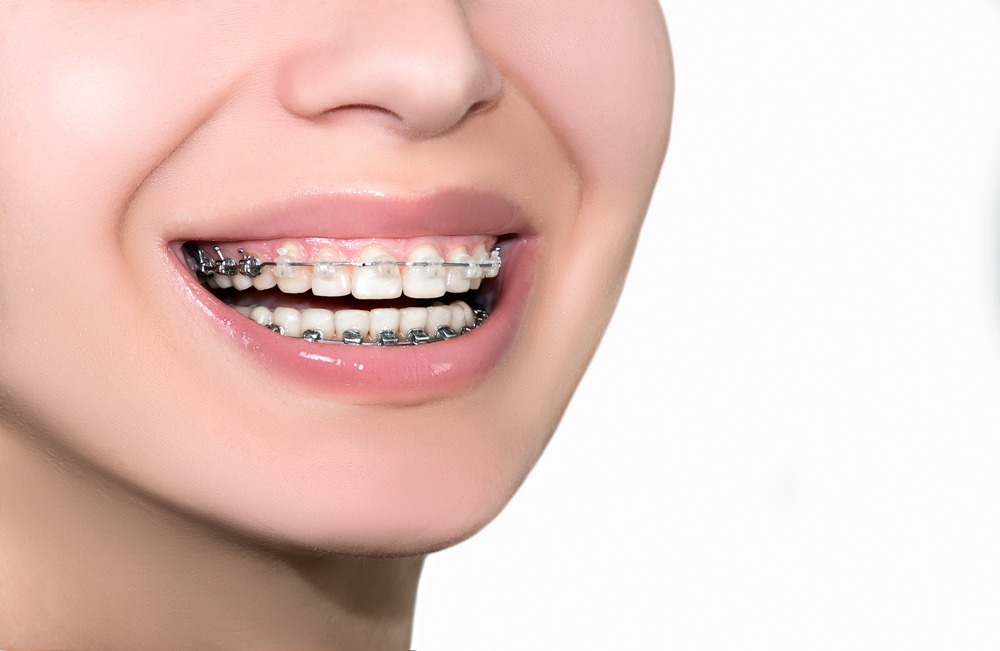 types of braces: self-ligating braces
