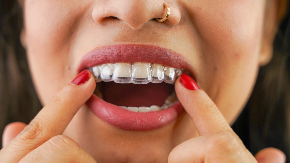 types of braces: invisible braces