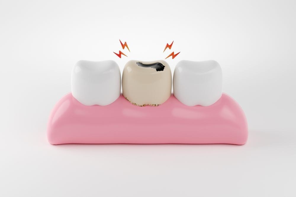 root canal treatment tooth discolouration