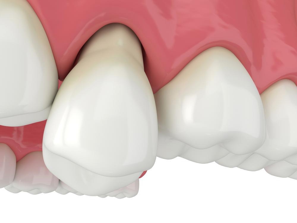 root canal treatment loose tooth